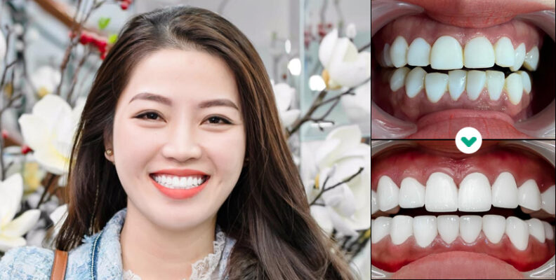 48H bọc răng sứ cao cấp Đức - Ăn nhai thoải mái, bền chắc trọn đời