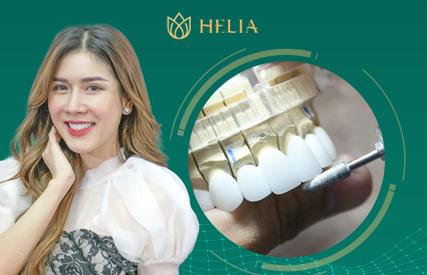 Bọc răng sứ, giải pháp khắc phục khuyết điểm nụ cười kém duyên