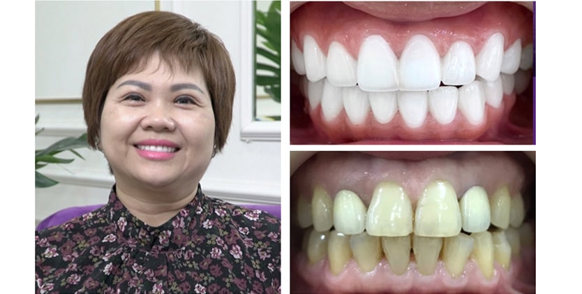 Những điều cần biết về bọc răng sứ