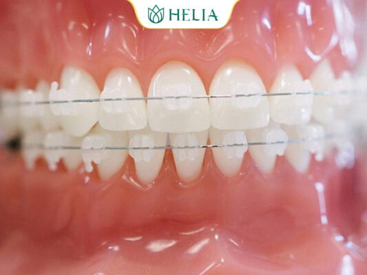 Niềng răng mắc cài pha lê trong suốt, tự nhiên