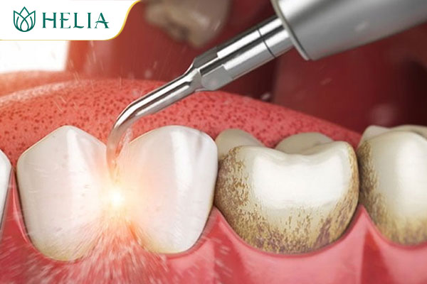 Thực hiện cao vôi răng, loại bỏ mảng bám gây bệnh răng miệng