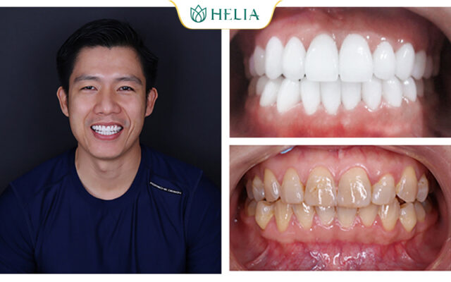 Khắc phục răng ố vàng/khấp khểnh/không đều bằng công nghệ bọc răng sứ Pico Zolid cao cấp Đức