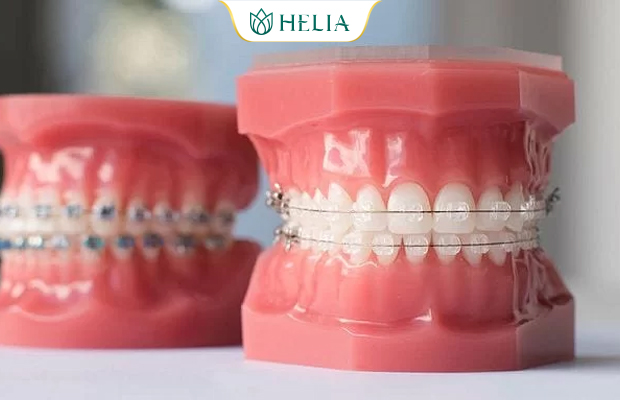 Niềng răng mắc cài pha lê trong suốt, tự nhiên
