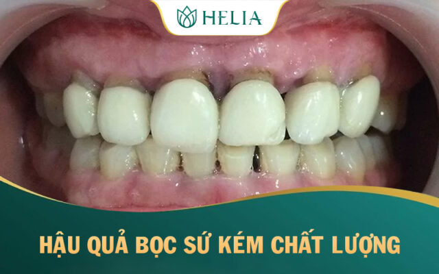 HELIA - Nói không với công nghệ bọc răng sứ giá rẻ