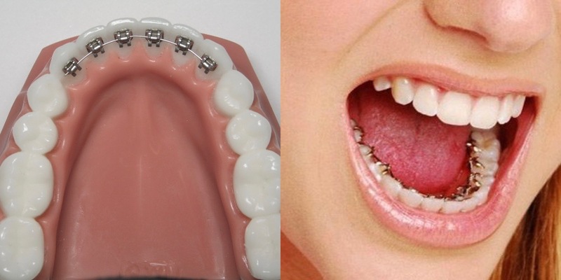 Niềng răng mắc cài mặt trong gây khó khăn trong ăn nhai