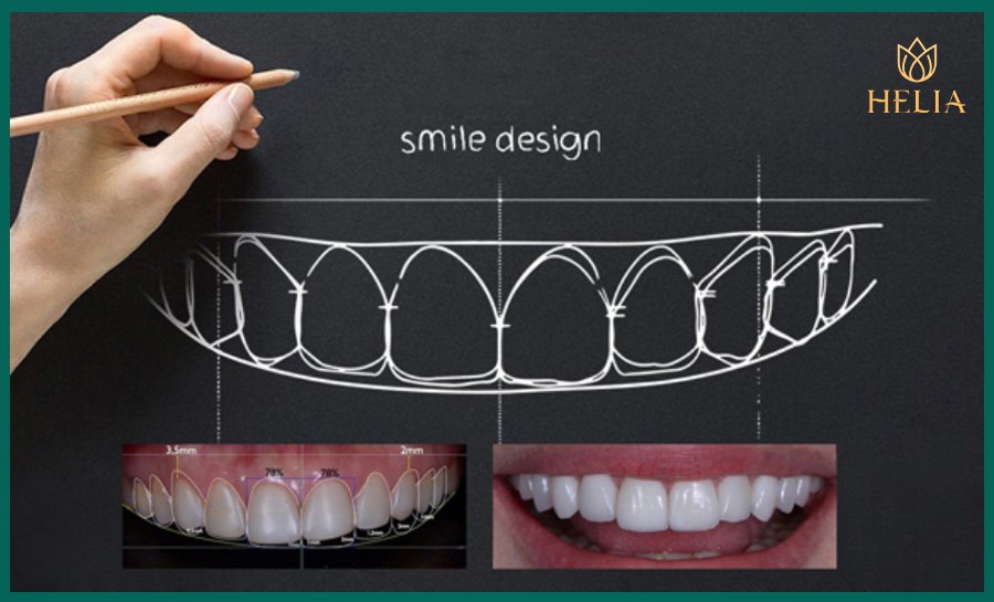 Công nghệ thiết kế nụ cười 4.0 độc quyền tại HELIA